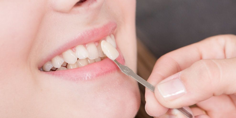 How Veneers Can Address Common Smile Concerns: Chips, Gaps, and Discoloration