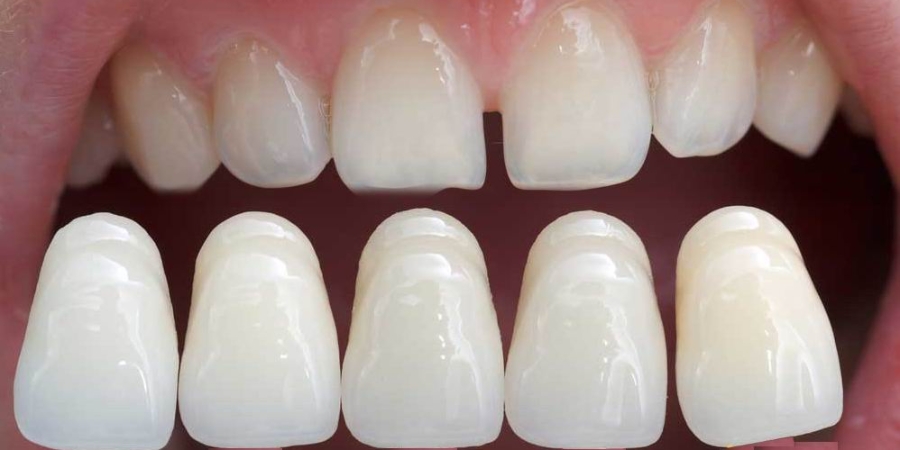 Why Porcelain Veneers Are Considered the Gold Standard in Cosmetic Dentistry?