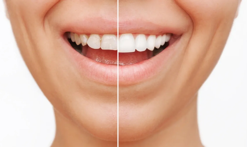 What Happens to Your Teeth Under Veneers?