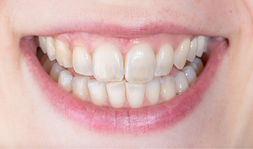 Can Teeth Whitening Damage Tooth Enamel?