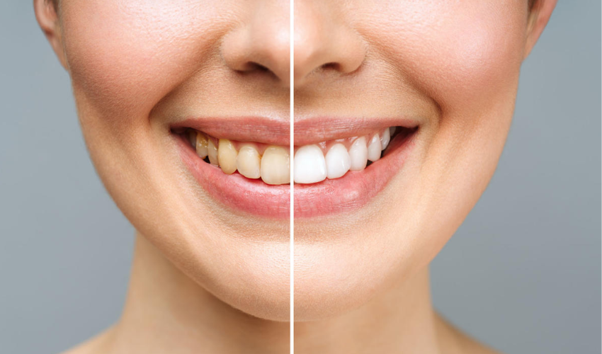 How to Treat Discolored Teeth with Cosmetic Dentistry?