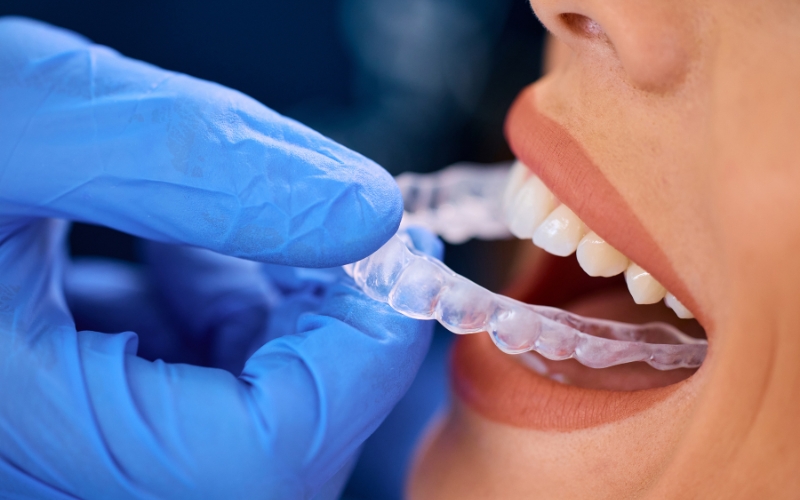 Can You Eat or Drink with Clear Aligners?