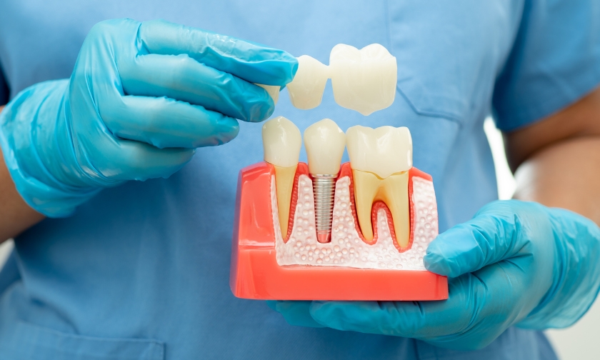 How to Care for Your Dental Implants for Longevity
