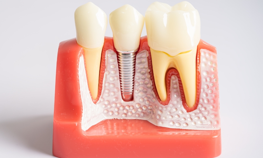 The Science of Osseointegration: What Happens After Your Implant Placement