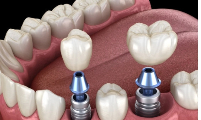 dental implants