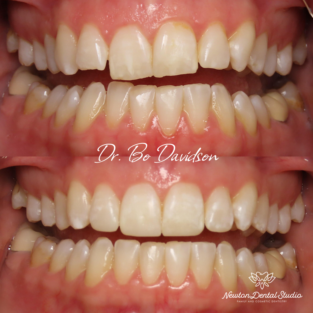 Clear Aligner Smiles by Newton Dental Studio