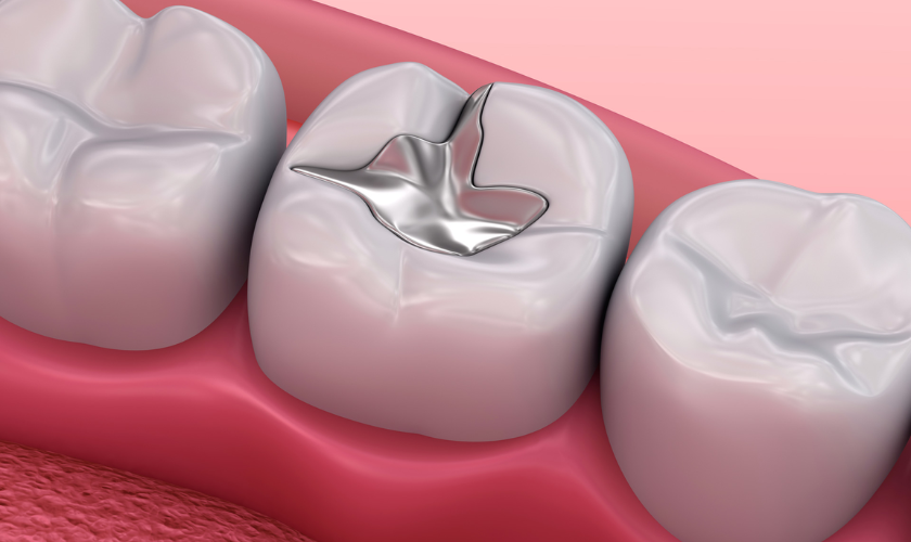 Mercury free dental filling material shown next to a tooth model