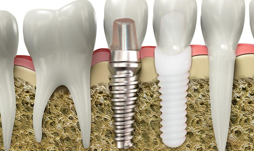 3D illustration comparing a titanium dental implant and a zirconia dental implant placed in the jawbone