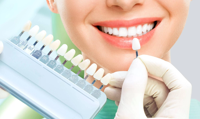 Dental veneers in various shades displayed for brightening comparison