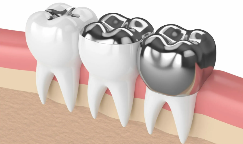 Amalgam dental filling shown next to a tooth model