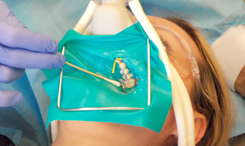 Dentist safely removing mercury fillings from a patient's teeth