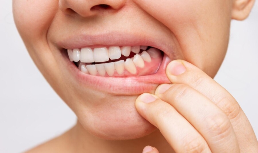 Close up of a person pulling down their lower lip to reveal inflamed gum tissue showing symptoms of severe gum disease