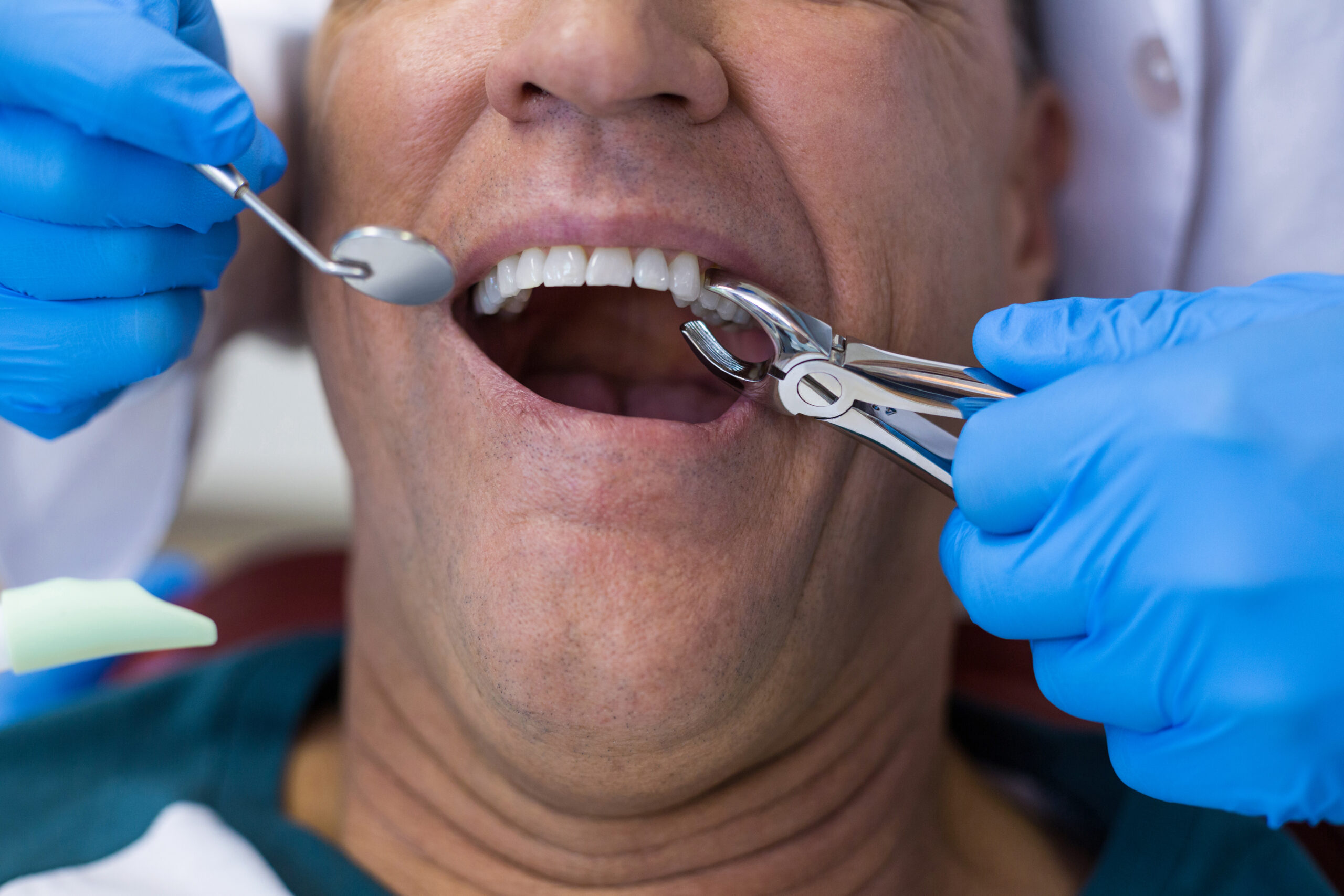 Dentist using forceps to perform a tooth extraction on a patient