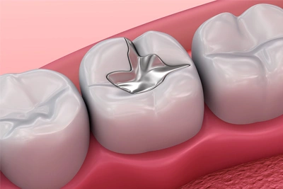 Close up of a mercury filling being removed from a tooth