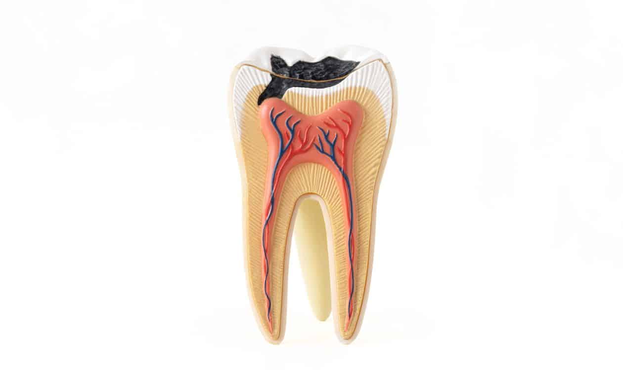stages of tooth decay
