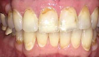 before tooth discoloration treatment
