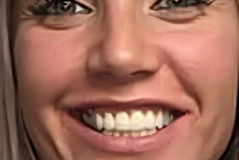 after smile makeover