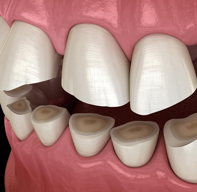 Bruxism