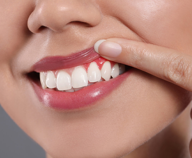Gum Disease