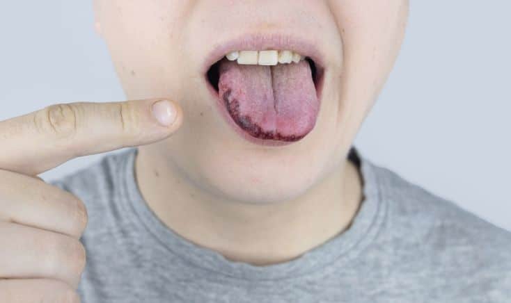 Vitamin Deficiency Causes Black Spots On The Tongue