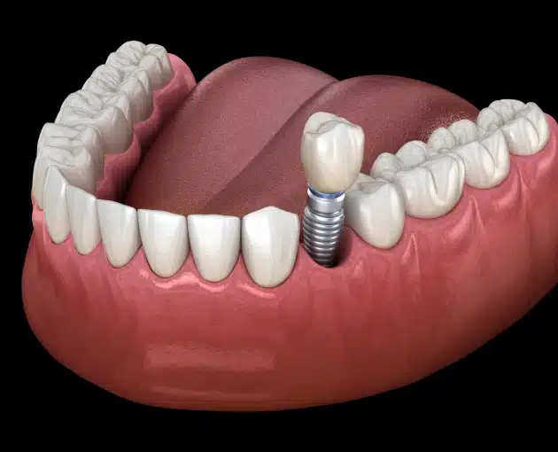 Dental Implants McMurray