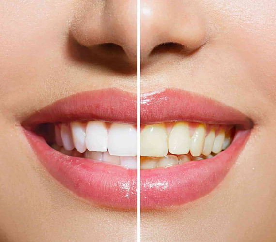 After teeth whitening tips