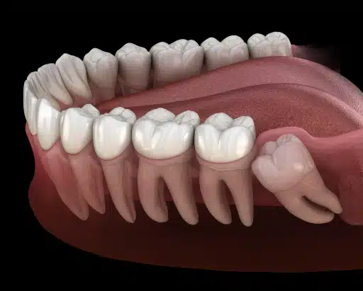 img-wisdom-tooth-extraction-How Do You Know If Wisdom Tooth Extraction Is Right for You