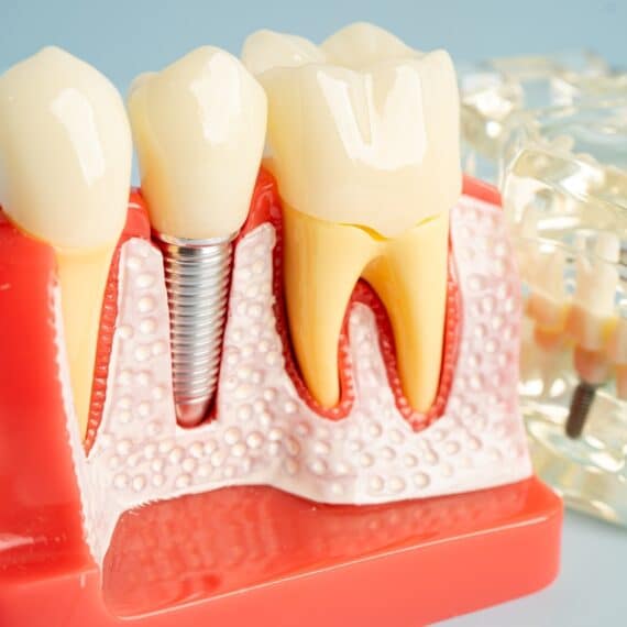 dental-implants-in-New-York