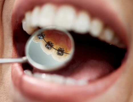 Choose Lingual Braces in New York for Discreet Treatment