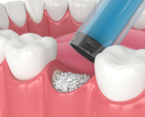 bone graft