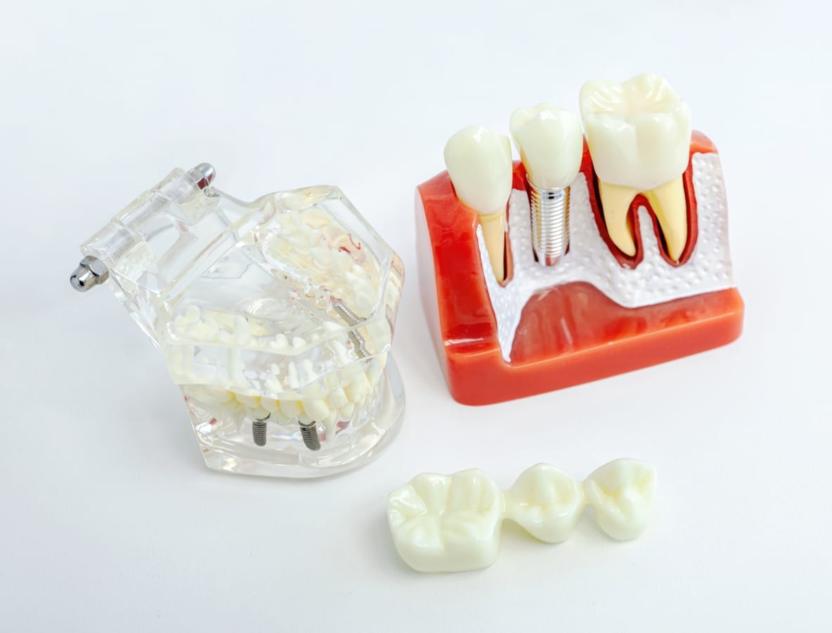 Dental Implants in Bakersfield