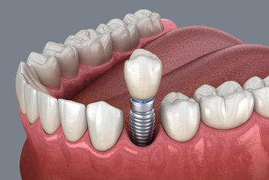 Missing Tooth & Dental Implant