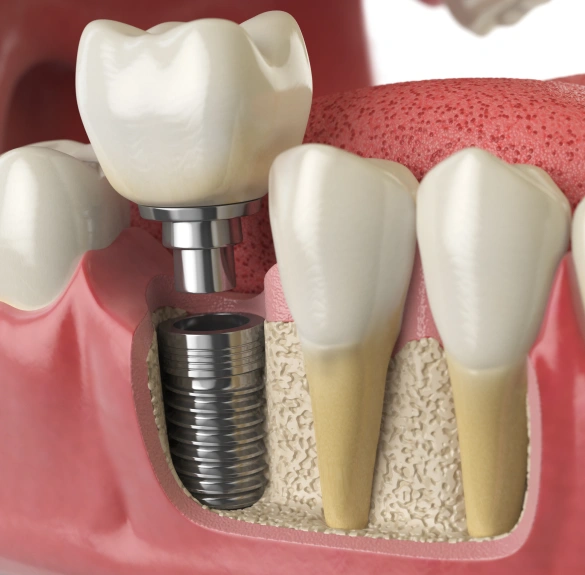 Rebuilding the Foundation Behind Your Smile