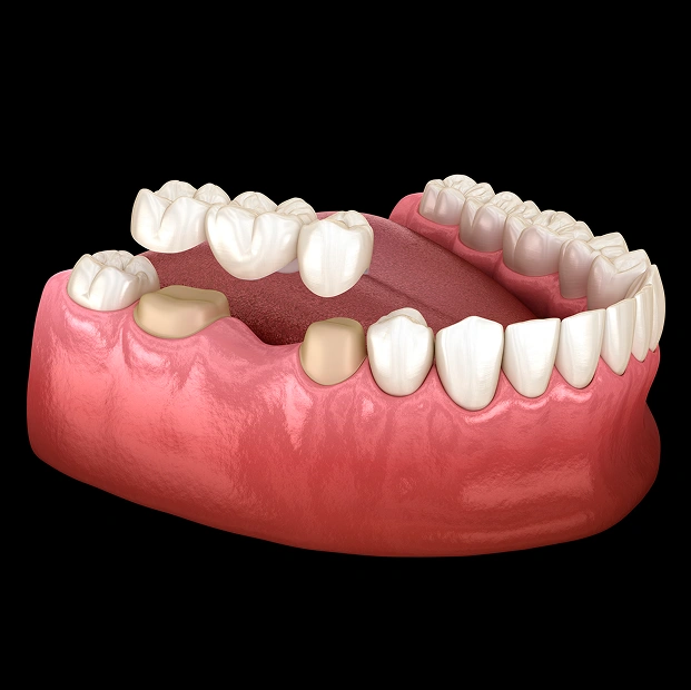 Full mouth dental implant restoration model on dark background