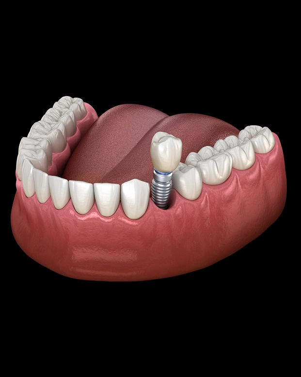 Lower jaw dental implant model showing implant supported denture