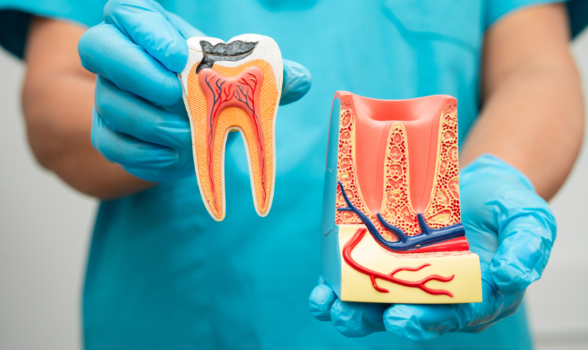 root canal