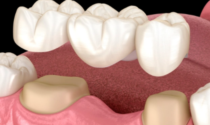 dental bridges