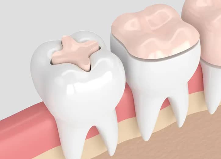 dental bridges in san antonio