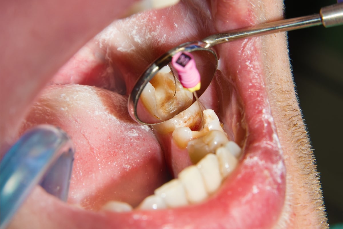 what to do if a root canal gets infected
