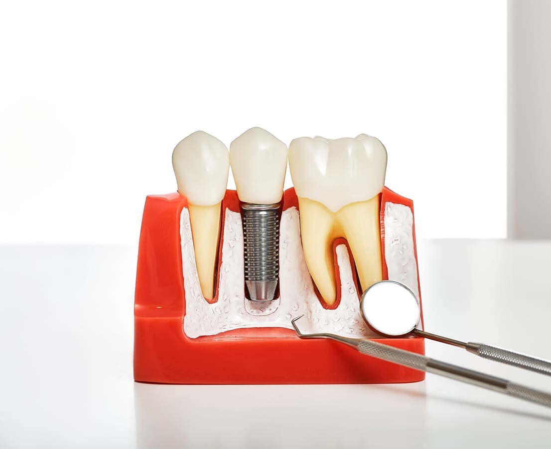 Dental Implants in