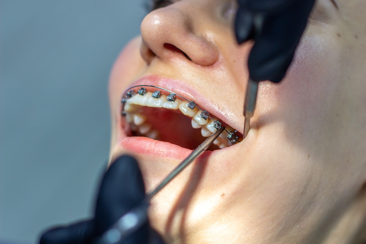 Dental-Bone-Grafting-Peachtree