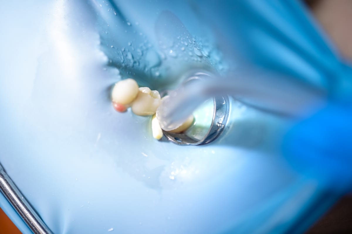 Root Canal Treatment in Florence