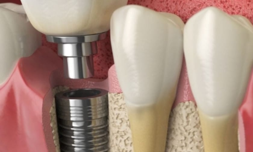 facial structure with dental implants