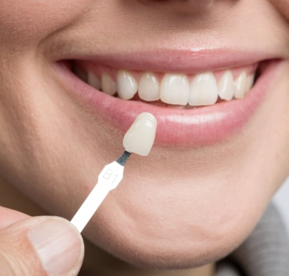 Dental Veneers