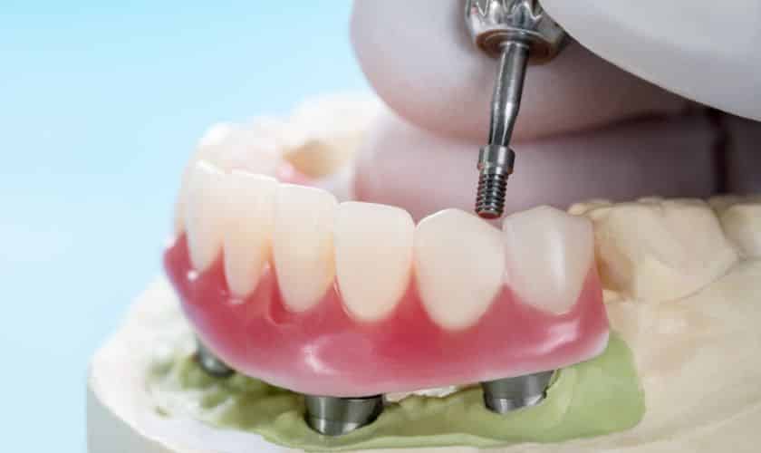 Different Types of Dental Implants | Pearl Dentistry Of Butler