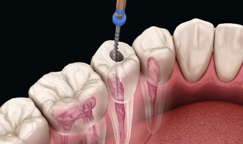 Root Canal Recovery