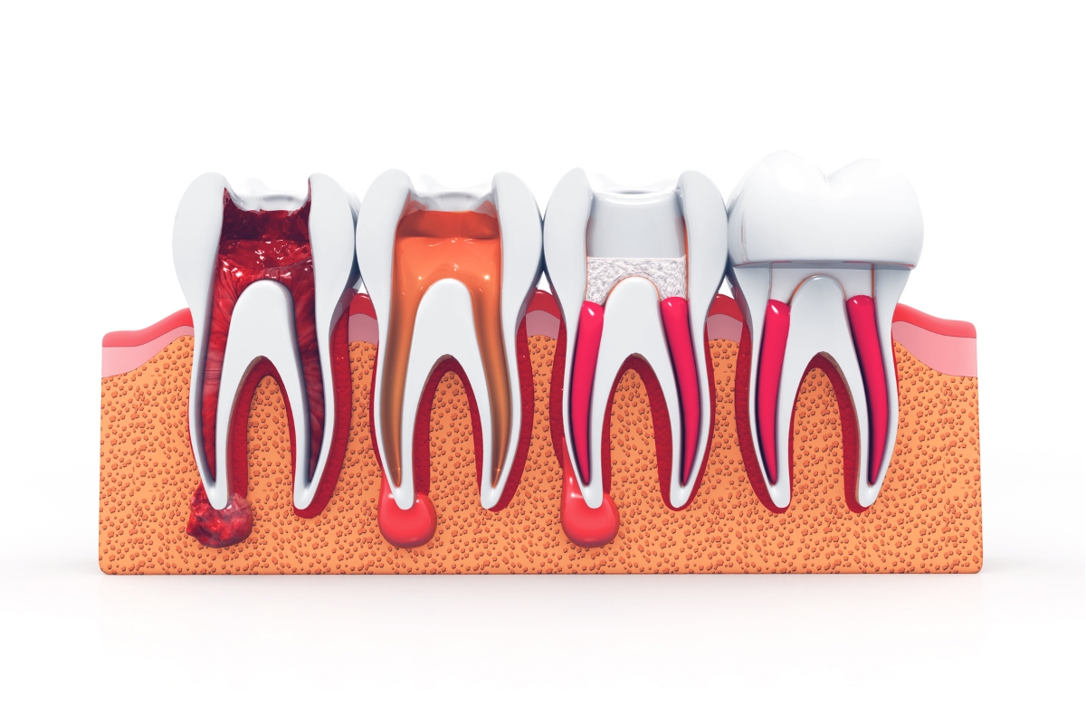root canal treatment in Coraopolis