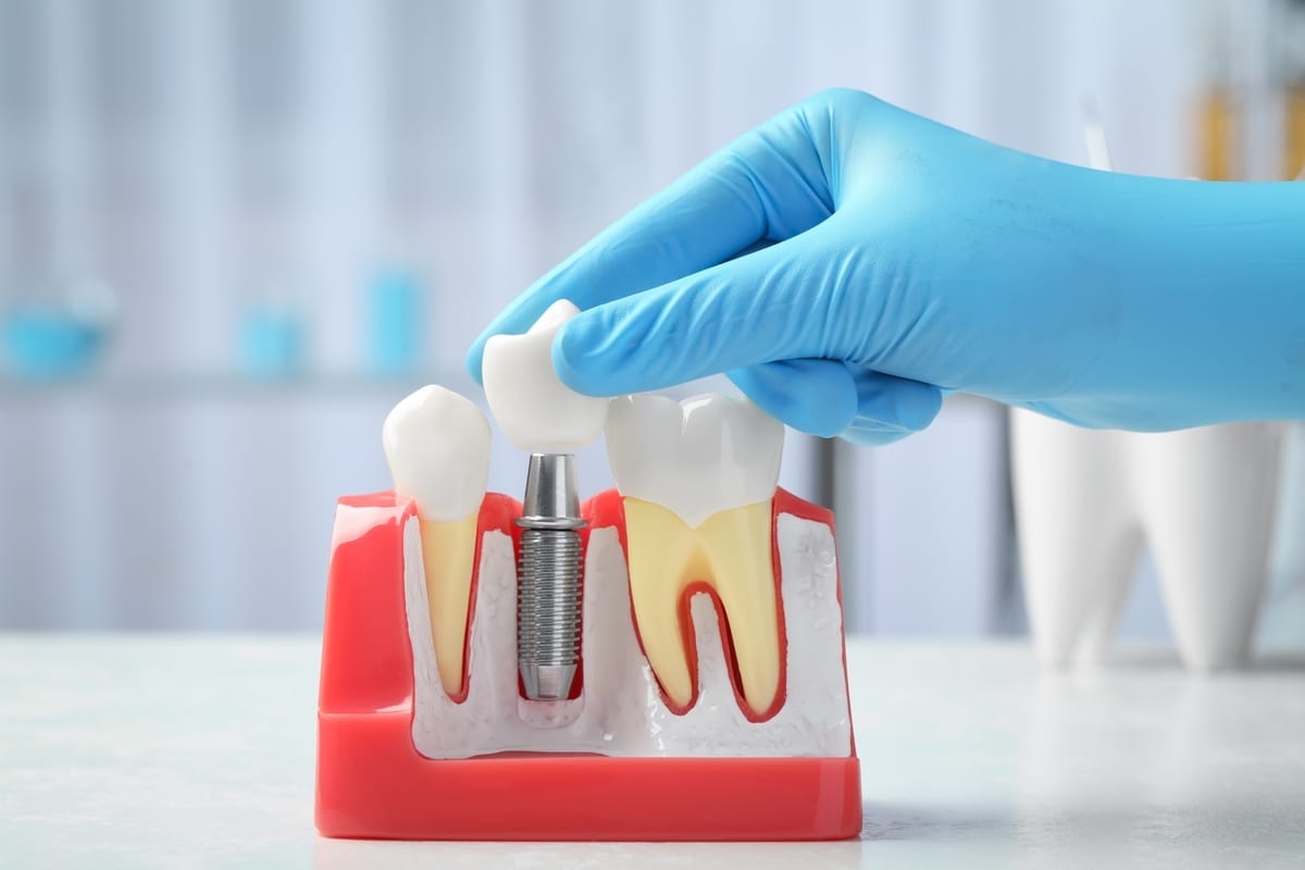 Dental Crowns in Pinole