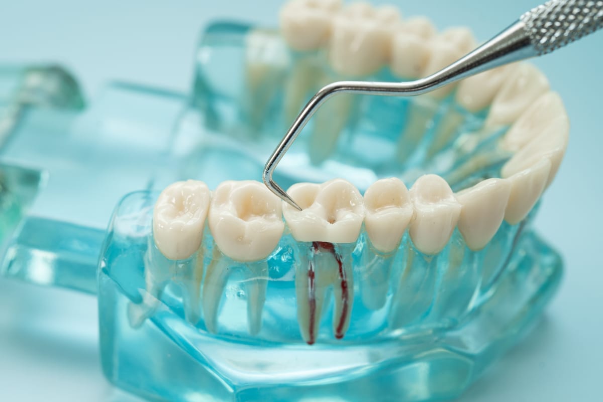 Root Canal Treatment in Pinole