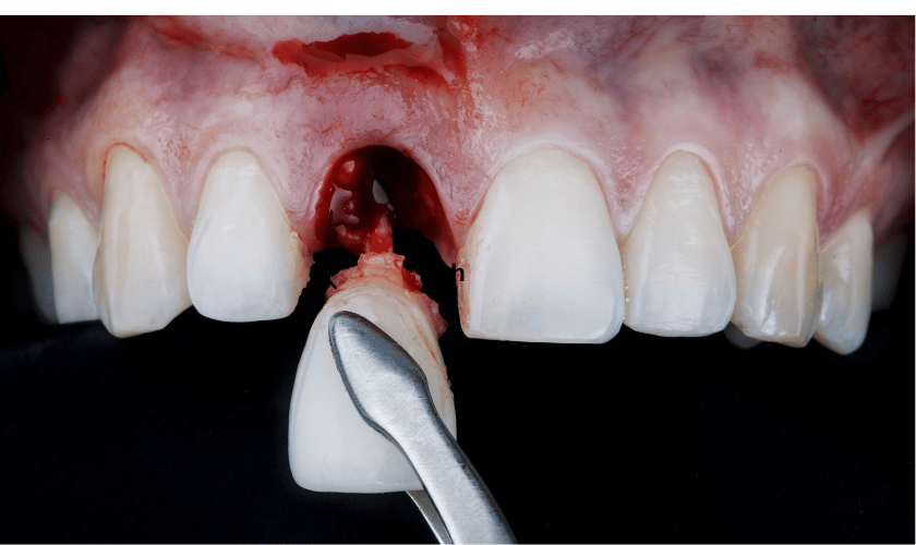 tooth extraction